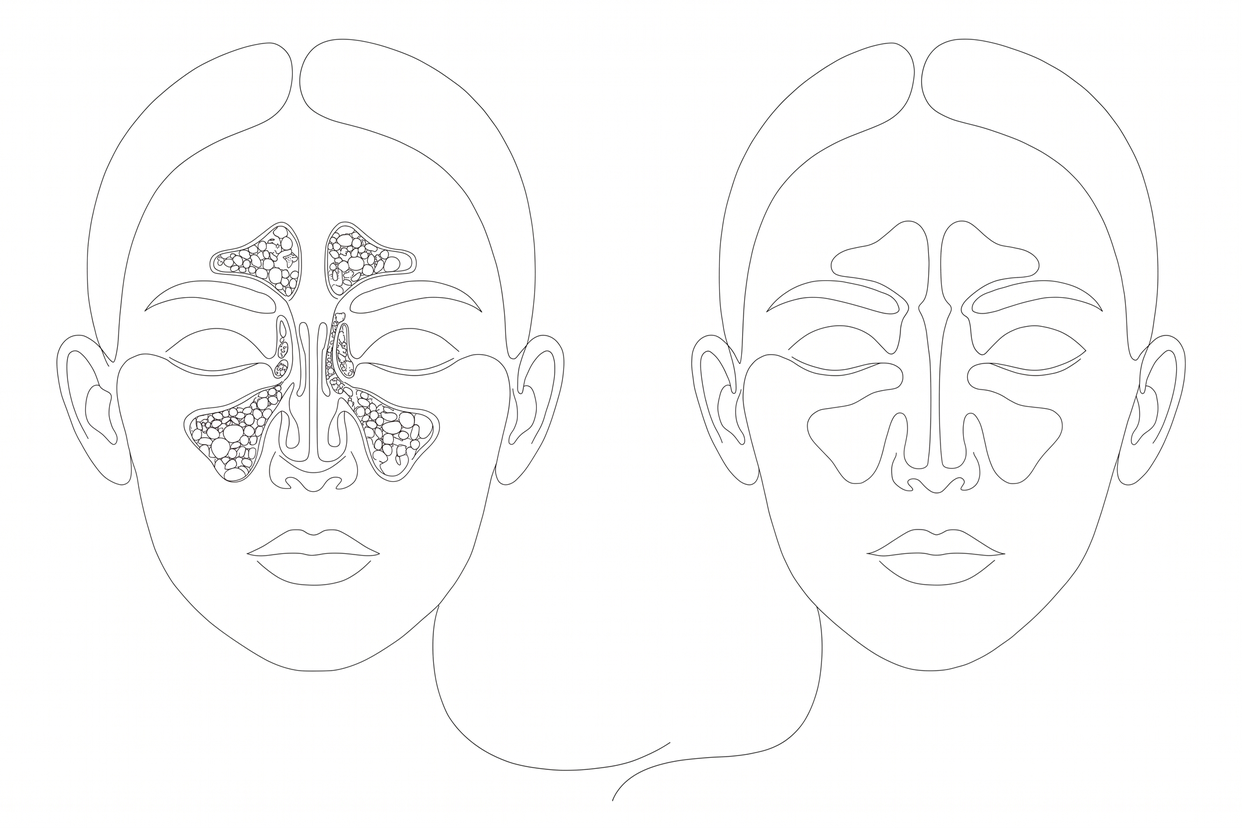Line-art illustration of a face showing blocked, inflamed sinuses on the left, compared to clear, open sinuses on the right — the outcome of endoscopic sinus surgery.