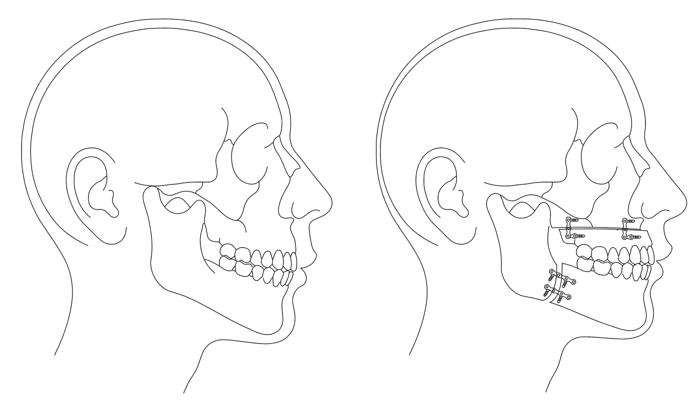 Line-art diagram of the skull in profile, comparing the position of the upper and lower jaw before surgery on the left with the advanced jaw position, secured with fixation plates, on the right.