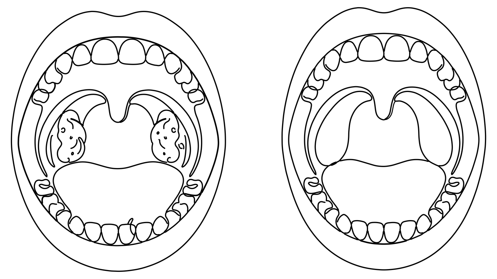 Line-art illustration of two open mouths — the left shows visible tonsils, the right shows the throat after an intracapsular tonsillectomy with the soft palate intact.