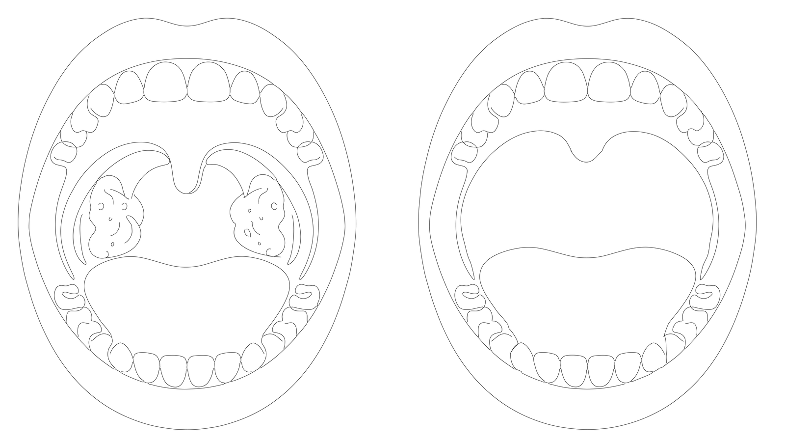 Line-art illustration of two open mouths — the left shows visible tonsils and a crowded soft palate, the right shows the wider airway after preservation pharyngoplasty.